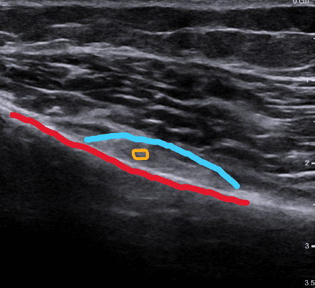 Ultraschallaufnahme einer gezielten Blockade eines Genikularnervs am Knie mit markiertem Knochen, Nerv und Lokalanästhetikum